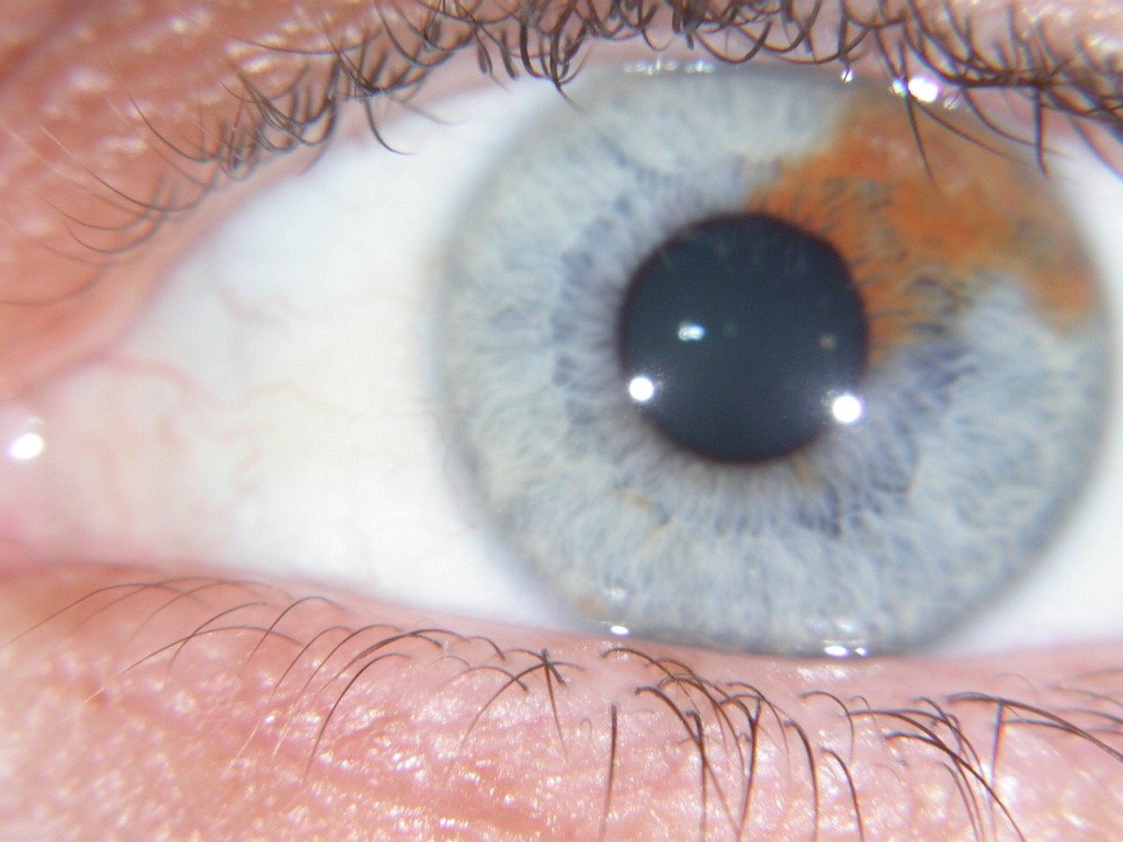 Eye of a person with a strong constitution